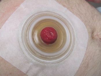 stool leaking around stoma|Stoma leaks 